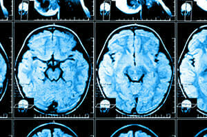 Brain X-Ray