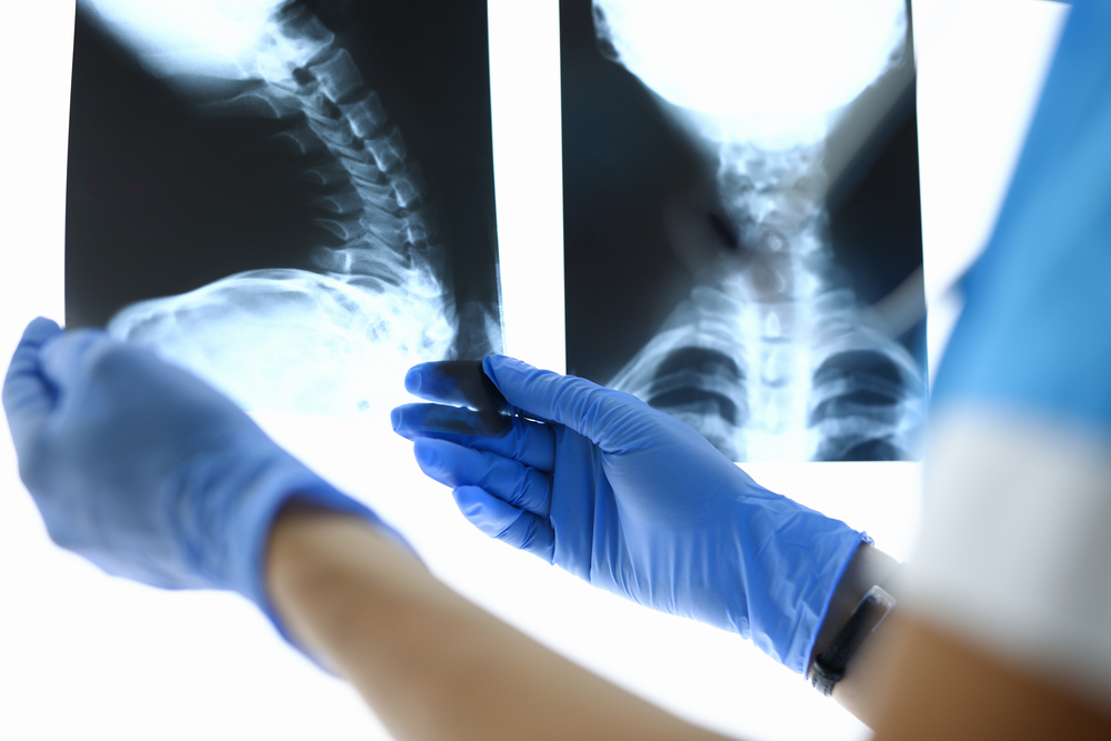 Doctor reviewing a spinal x-ray